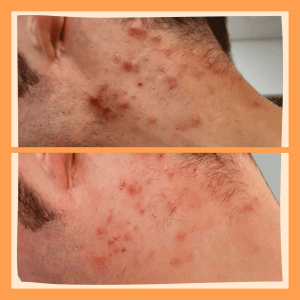 Tratamiento para la eliminación del acné y marcas del acné