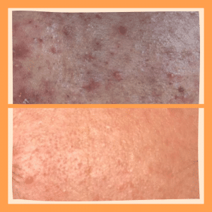 Tratamiento para la eliminación del acné y marcas del acné