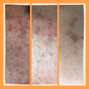 Tratamiento para la eliminación del acné y marcas del acné