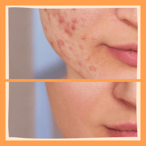 Tratamientos para eliminar el acné